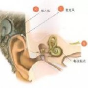人工耳蜗植入术后该如何护理？人工耳蜗植入术后患者要注意哪些问题？