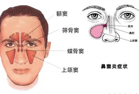 鼻窦炎:鼻窦炎多是菌类感染所致,可单一病症存在.