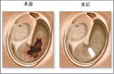 耳膜穿孔怎么办?