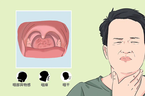 慢性咽炎会癌变吗图片