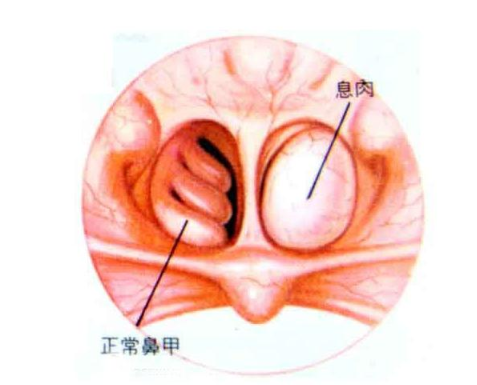 导致鼻息肉发病的主要原因是慢性鼻炎,鼻窦炎的脓性分泌物的长期刺激