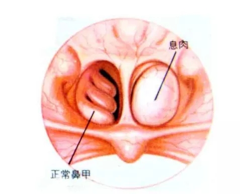 鼻孔里面的正常情况图图片