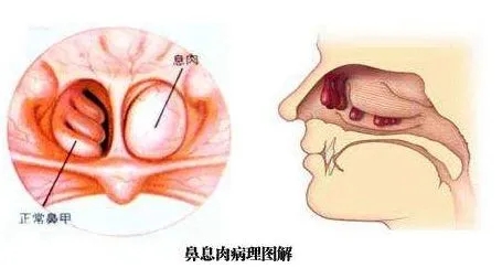 鼻腔照片图片