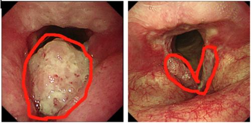 咽喉癌图片早期图片