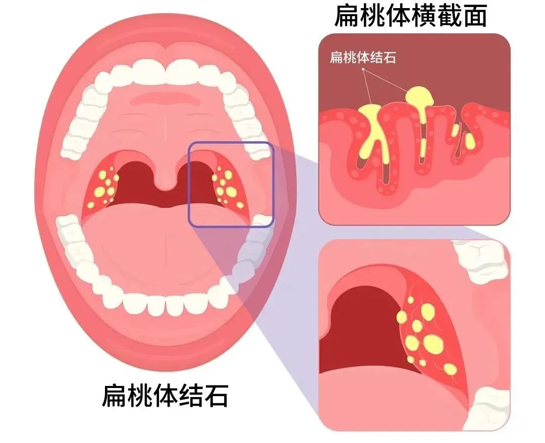 扁桃体结石角化照片图片